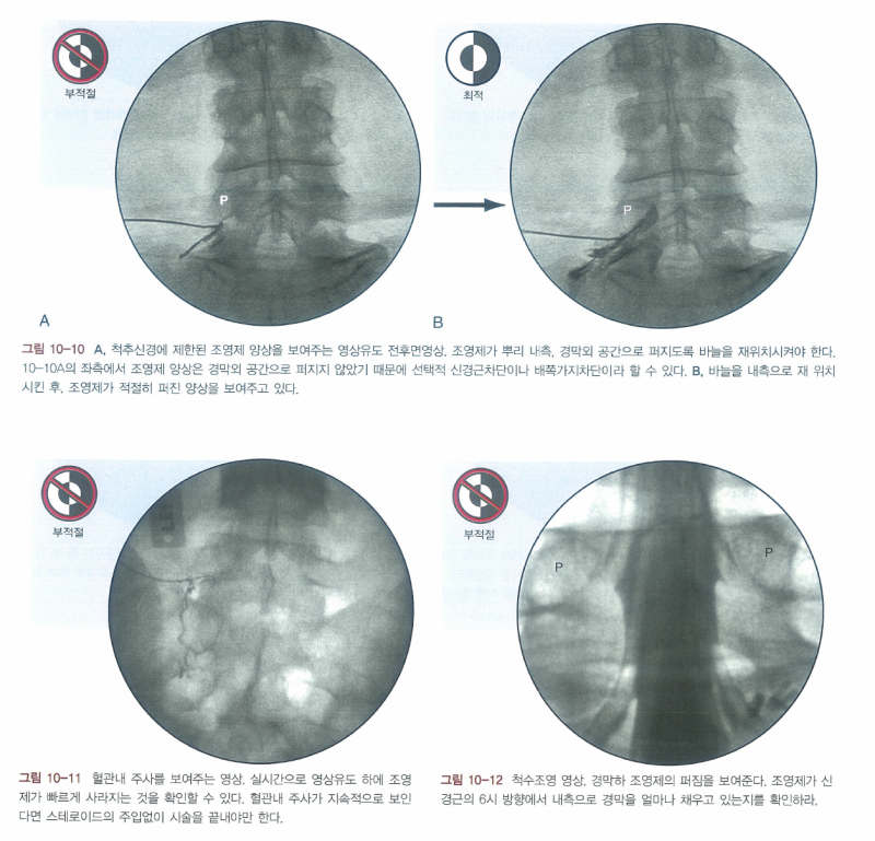 [외래/주사/척추]L-SNRB Selective Nerve Root Block /transforaminal block ...