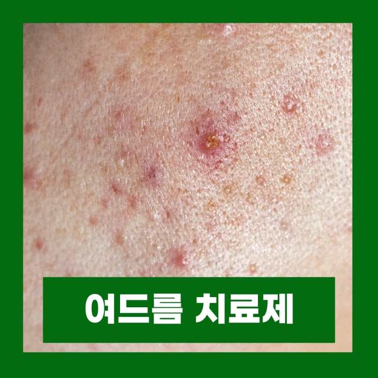  1세대 여드름 치료제 스티바A 단종 3세대 디페린(아다팔렌) 4세대 아클리프 크림 효능 부작용