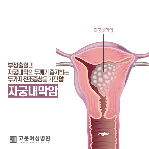부정출혈과 자궁내막이 두꺼워진다면 빨간불! 자궁내막암 검사가 필요할 때!