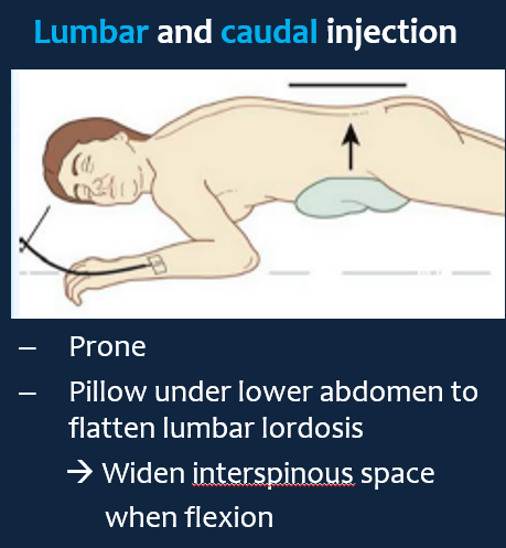 [외래/주사/척추]L-SNRB Selective Nerve Root Block /transforaminal block ...