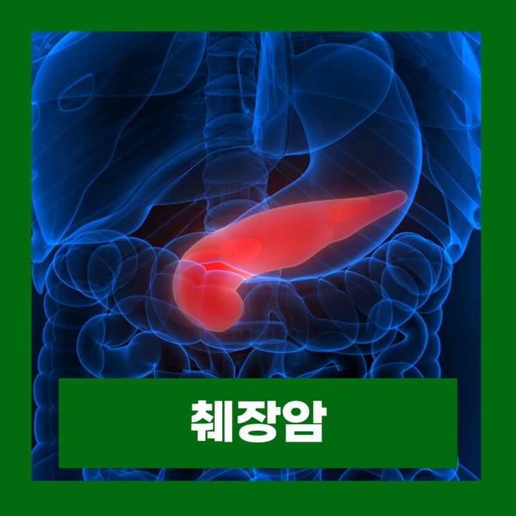  췌장암 원인 및 초기증상 등통증 위치 완치율 알아보기