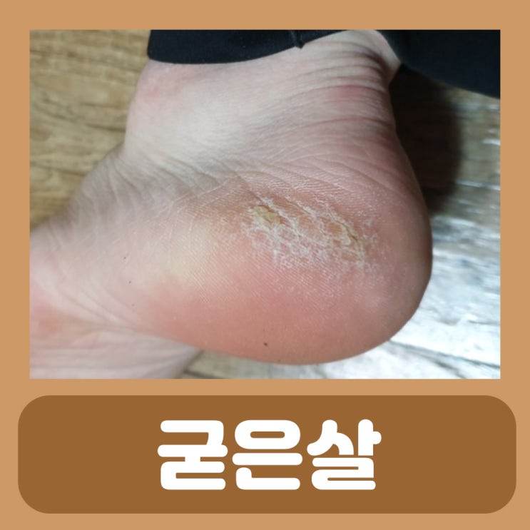  발바닥 굳은살 위치 : 손가락 새끼발가락 발뒷꿈치 복숭아뼈 굳은살 제거