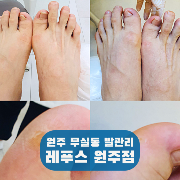 원주 내성발톱 레푸스 원주점, 무실동에서 무좀 발각질 관리까지