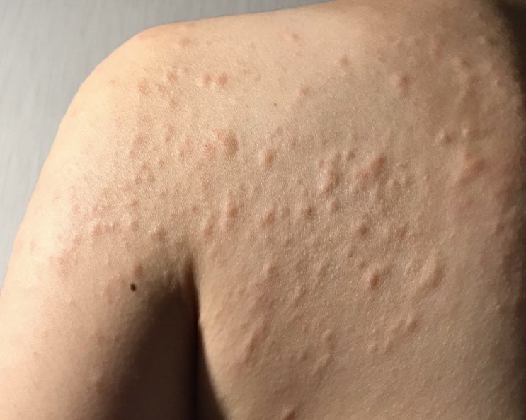  콜린성 두드러기란 무엇일까요? 증상 및 치료 방법