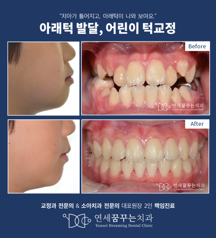 아래턱이 발달한 어린이(주걱턱)에서 턱 교정을 통한 얼굴의 변화 아래턱이 발달한 어린이(주걱턱)에서 턱 교정을 통한 얼굴의 변화