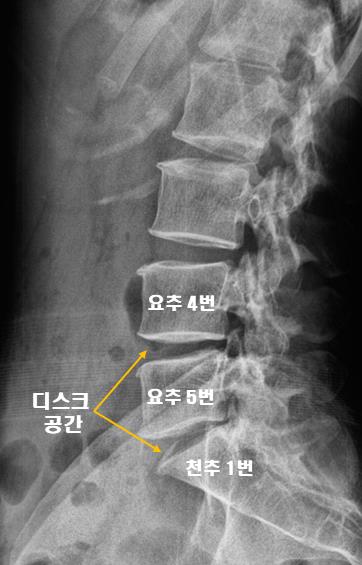  허리디스크탈출증, 주사치료했는데 하루만 효과 있어요