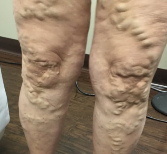  하지정맥류 의미 주요증상 치료방법