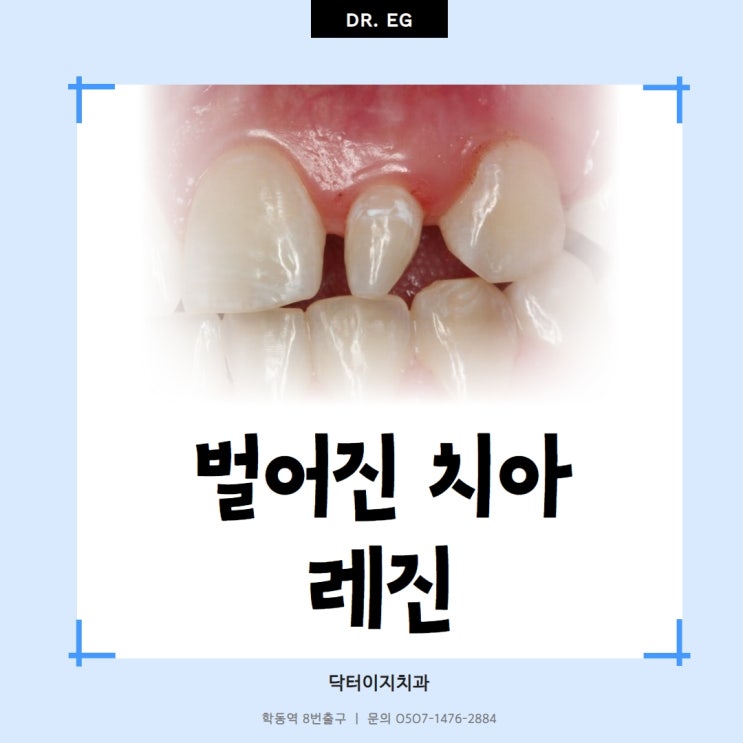 벌어진 치아 레진 치료 자연치아 보존하는 강남 학동역 닥터이지치과