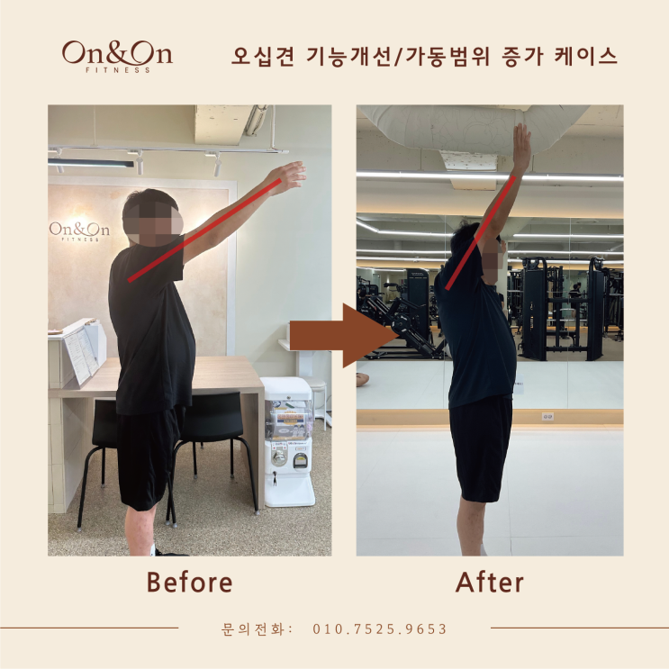  '오십견 스트레칭'의 확실한 효과/ Before&After