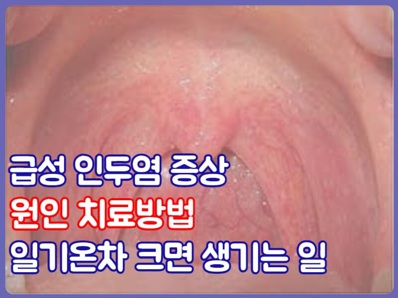 급성 인두염 증상 원인 인두염 치료방법