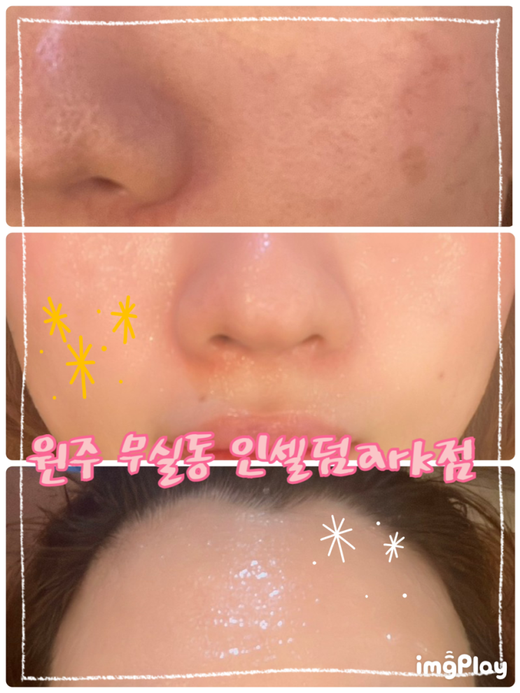  직접 써보고, 들어보고, 알아보라~ 선택은 내가 하는 것! 원주피부관리 "인셀덤 ark점"