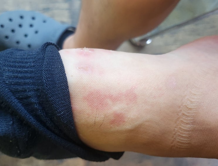  한포진,조갑주위염 증상,처방,원인/강남구,강남구청,청담역 근처,삼성동,청담동 피부과 진료 휴피부과 추천,진료시간,점심시간,주차,예약여부