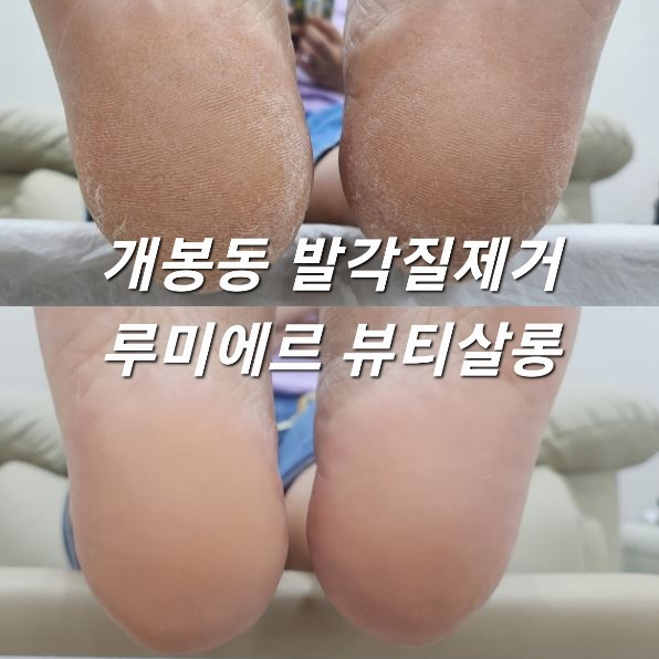  고척동/ 개봉동 발각질제거 루미에르 뷰티살롱 :: 발각질관리로 맨질맨질 뒤꿈치