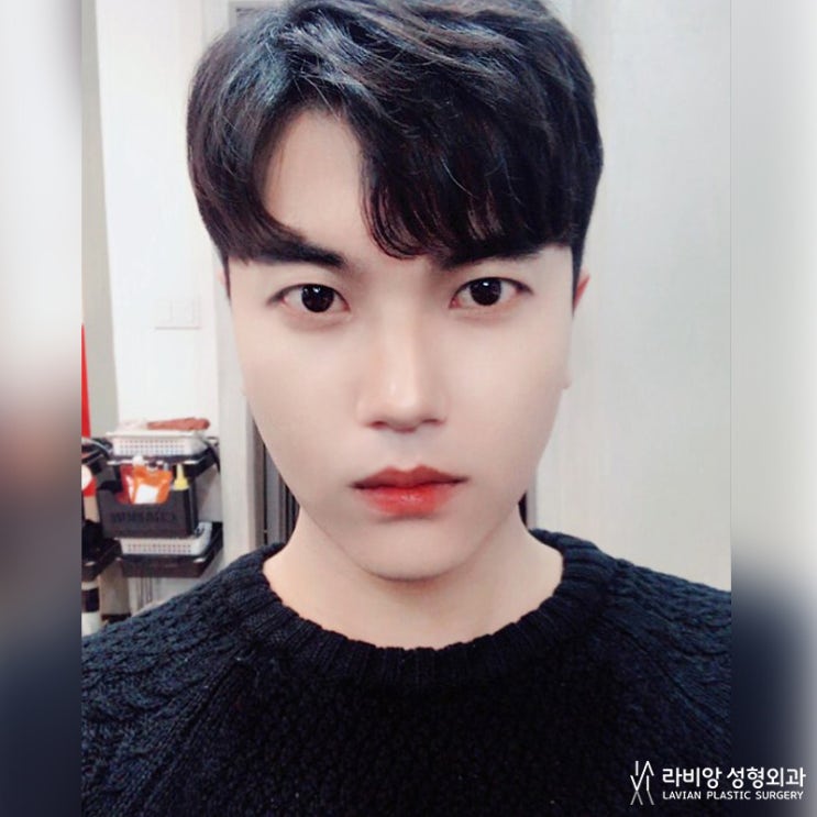  남자눈매교정 안검하수 교정 후기까지
