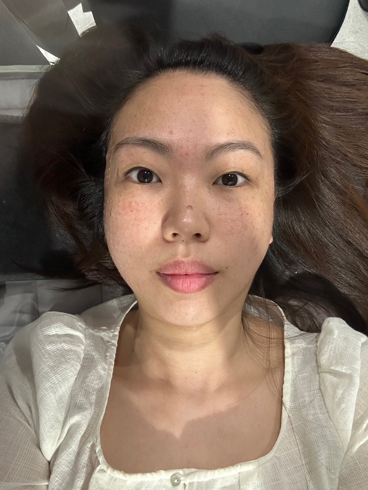  압구정 피부과 엑소좀 티파니 멀티웨이브 칙칙하고 트러블로 고민인 피부케어