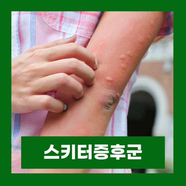  스키터증후군 모기 알레르기 증상 알러지 치료방법