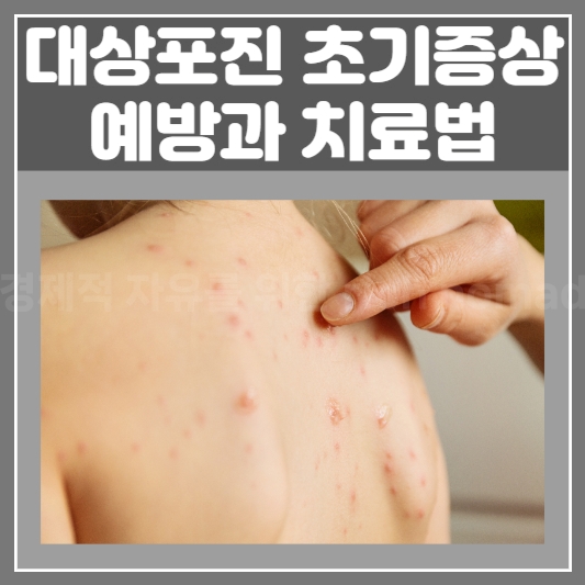  대상포진 초기증상 예방 및 치료법 건강을 지키는 방법