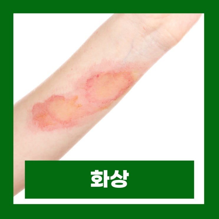  1도 2도 3도 4도 화상 단계별 증상 응급처치 방법