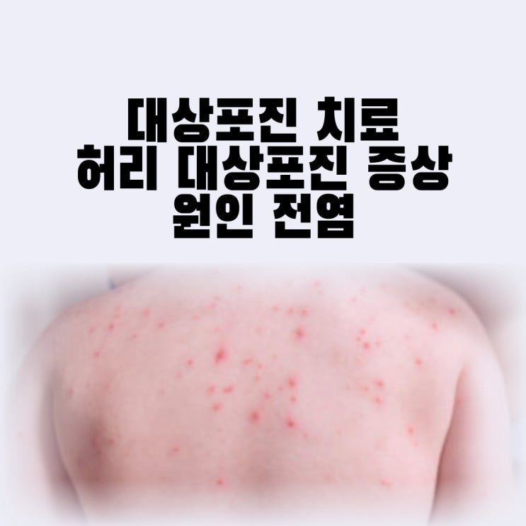 대상포진 치료 주사 허리 대상포진 증상 원인 전염