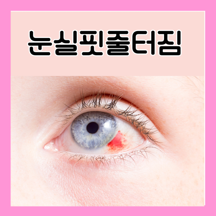  눈핏줄터짐 결막하출혈 충혈 차이 원인 제거