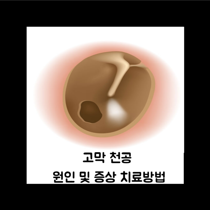 고막 천공 원인 및 증상과 치료방법