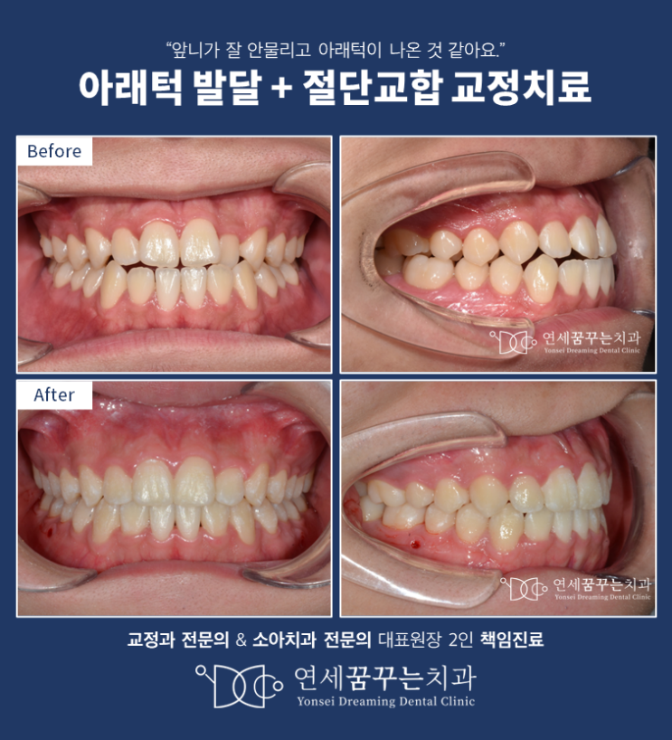 아래턱 발달과 앞니 개방교합을 보이는 성인의 교정치료 케이스