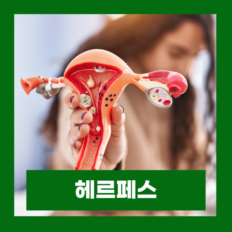  여자 헤르페스 2형 여성 생식기 성병 증상 전염원인 치료방법