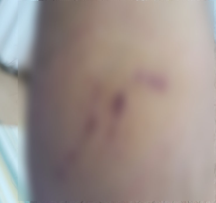  개 물림 과실치상죄 인터넷으로 온라인 고소 후기