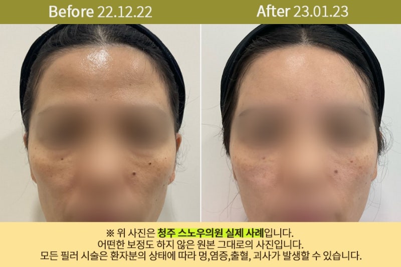청주이마필러, 의사가 말하는 효과 3가지