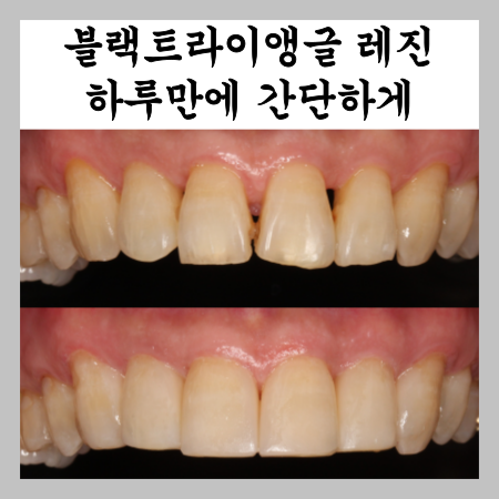  이 사이 벌어짐, 블랙트라이앵글 레진 하루만에 간단하게