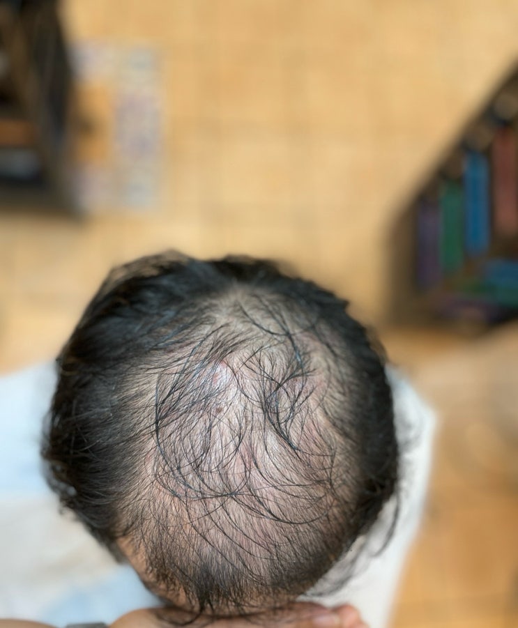 기장정관에서왔어요 가을타기전에 남성탈모펌 부산탈모전문사상르네시떼헤어/ 동래구영도구해운대구사상구북구남구수영구동구기장군금정구김해시울산시거제시구미시대구시남해