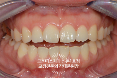  앞니 개방교합과 돌출을 주소로 내원한 2급 부정교합치료증례 신촌교정치과 고운미소 신촌1호점 치료증례