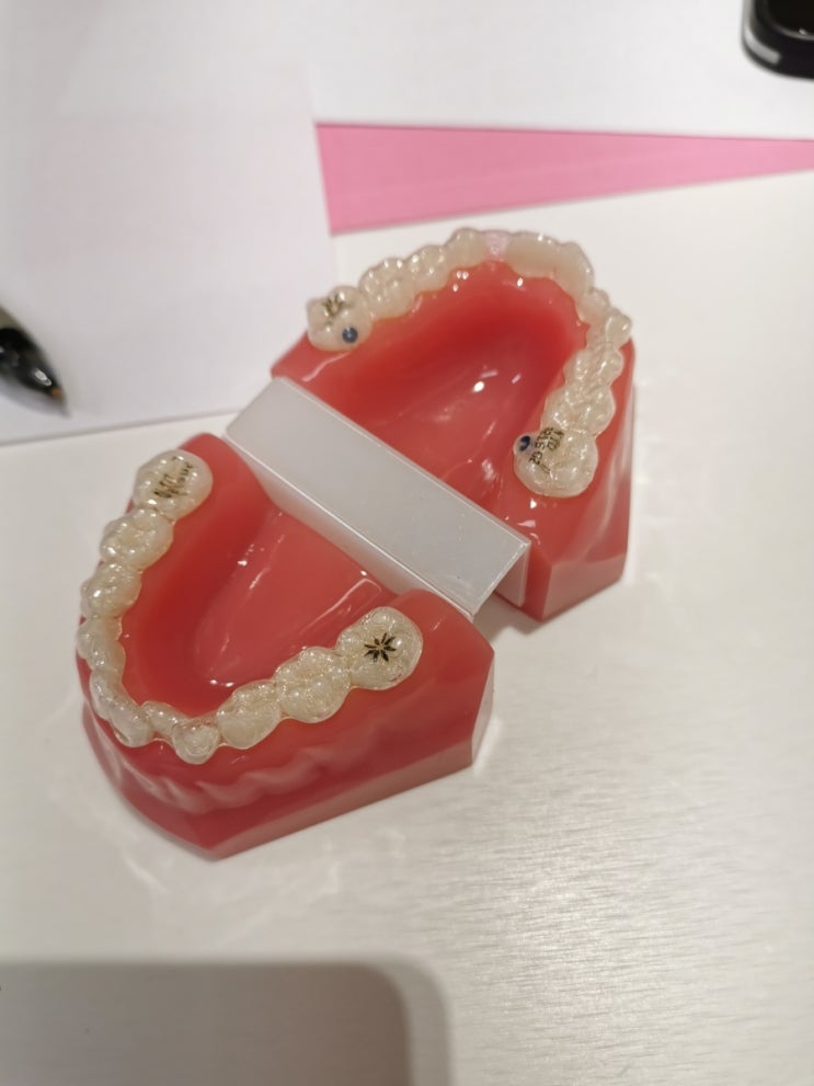 독일 룩셈부르크는 어린이 치아교정도 의료보험이 된다(?)