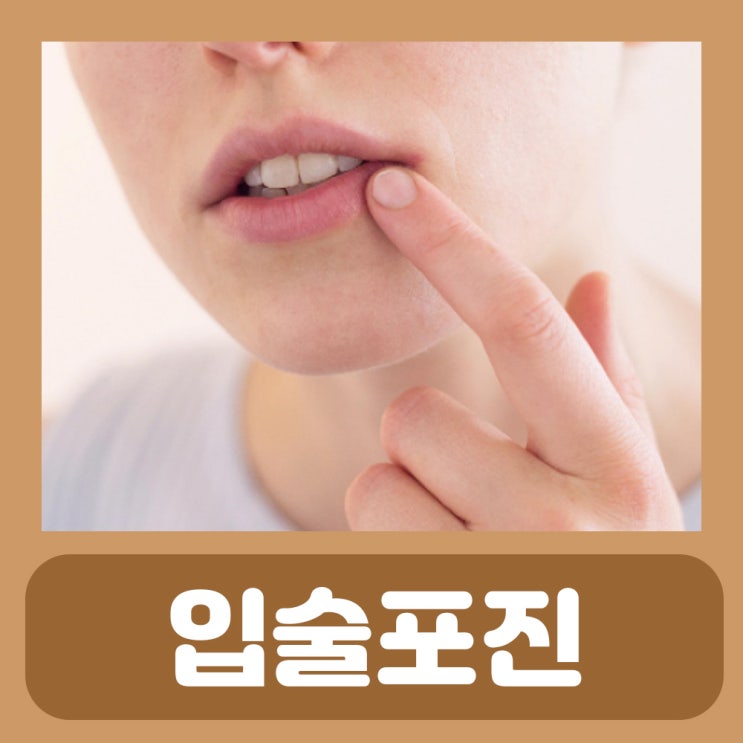 입술 포진 치료 약 습진 염증 부르틈 연고 입술 안쪽 물집 간지러움 알레르기 구순포진