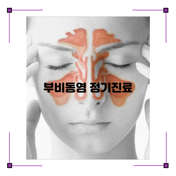  부산 개금 백병원 부비동염 축능증 정기진료 쌍코피 났어요.