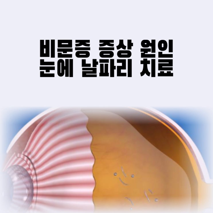  비문증 증상 원인 눈 비문증 노안 눈에 날파리 치료 완화