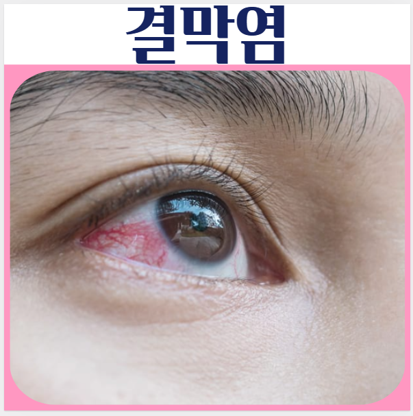 결막염 증상 종류 전염 눈가려움 치료 방법