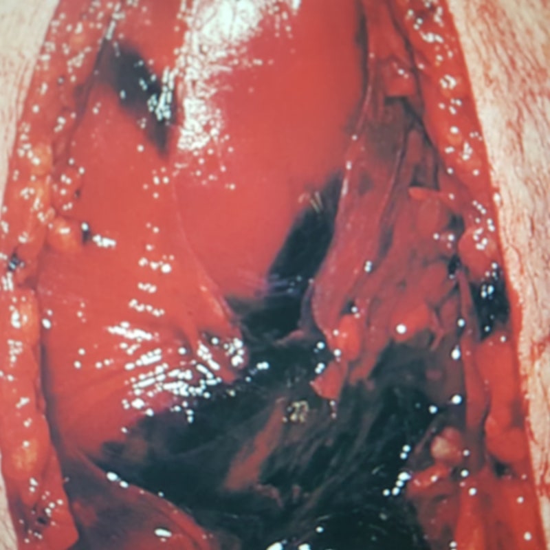 횡문근융해증 증상, 치료, 병원, 간수치, 수치, 음식, 운동, 근육통, 응급실 정보 확실히 알아....