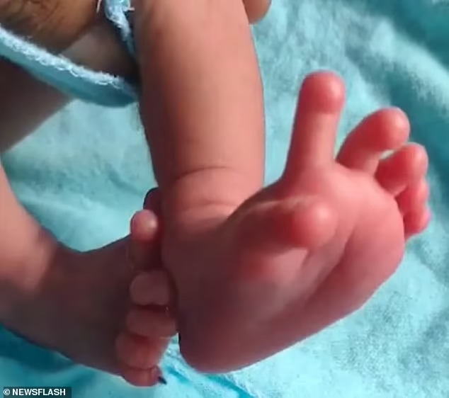[해외/이슈] 힌두 여신의 재림? 손가락 14개 발가락 12개 인도 아기 탄생!!!