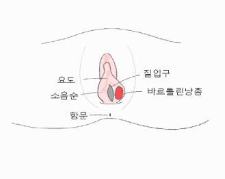 바르톨린선 낭종 증상과 수술 후기