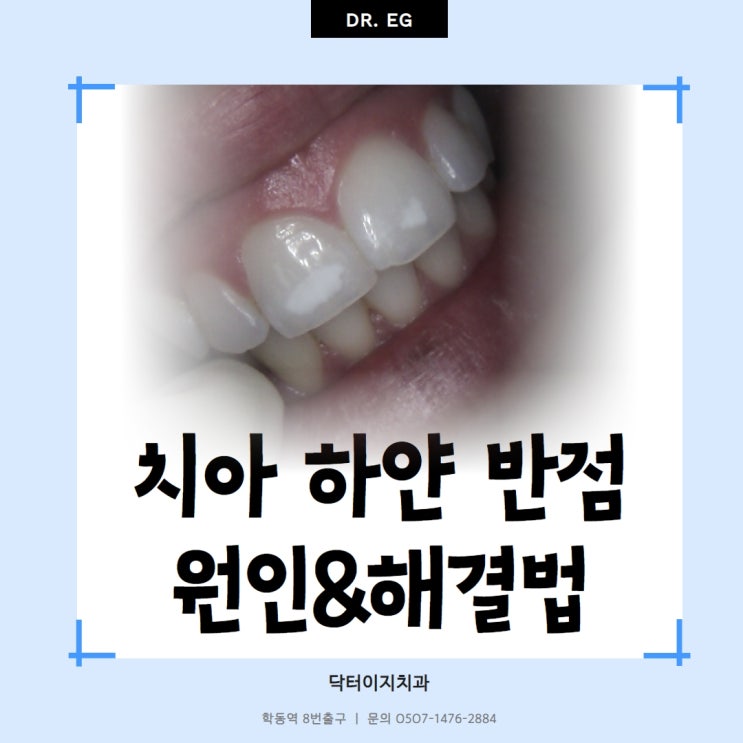 강남 학동역 닥터이지치과 치아 하얀점 반점치 원인과 치료방법