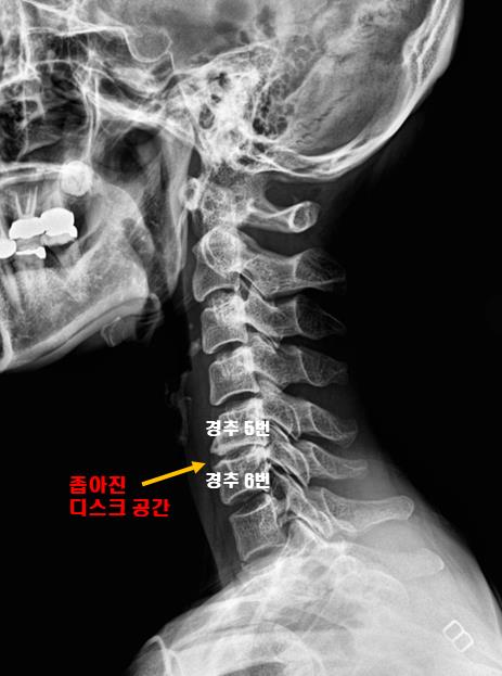  봉선동정형외과, 손과 팔의 통증과 힘이 빠지는 이유