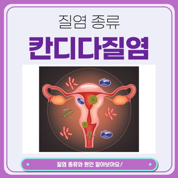  질염 종류 원인 치료 칸디다질염 알아보아요