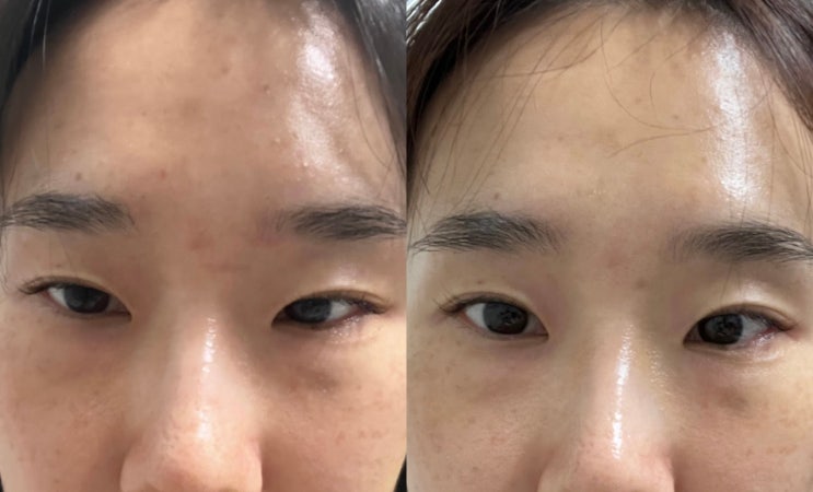  눈썹실리프팅잘하는곳에서 눈꺼풀처짐 교정하고 온 후기