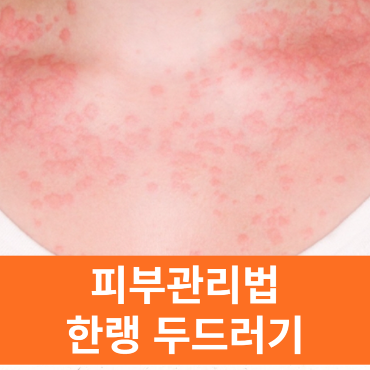  한랭 두드러기 가을부터 조심