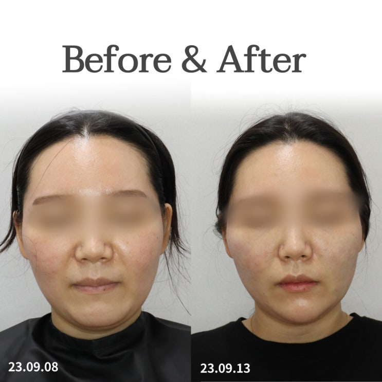 센텀 실리프팅 피부과 의사가 솔직하게 말씀드립니다. 센텀 실리프팅 피부과 의사가 솔직하게 말씀드립니다.