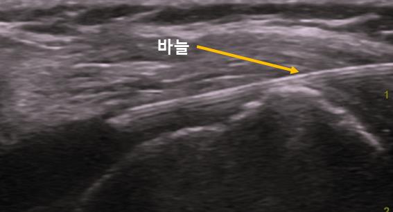  진월동정형외과, 극상근 파열과 어깨 통증 원인