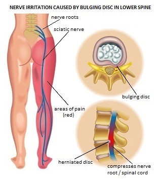 왼쪽, 오른쪽, 한쪽, 양쪽 다리 저림 양상에 따른 원인, 관련 질병