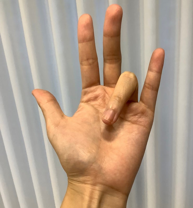  손가락이 딸깍 걸려요 손가락이 잘 안 펴져요, 방아쇠수지증후군