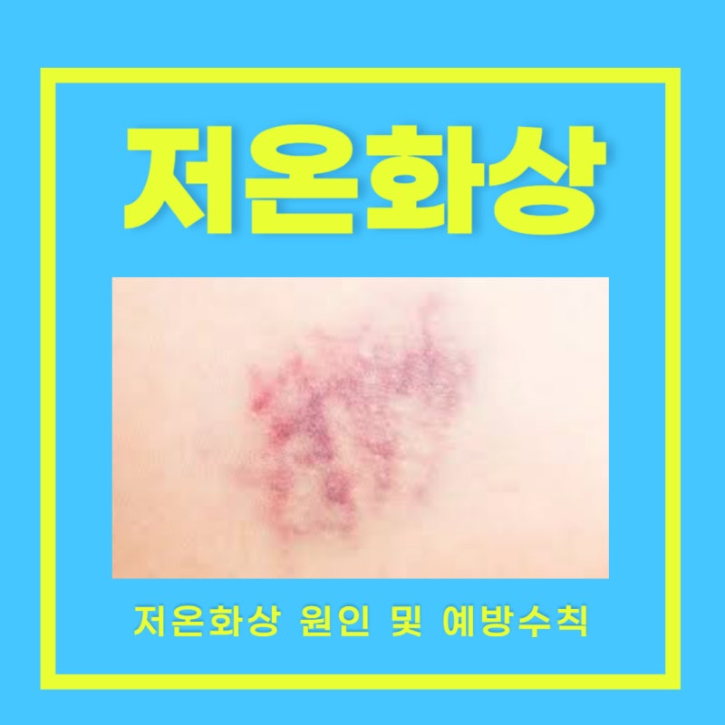 저온 화상 연고 저온화상 치료 저온화상 예방수칙